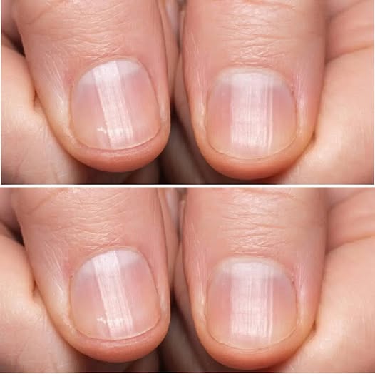 Having Striped Nails Could Mean That Your Body is!